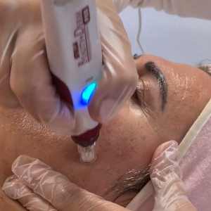 Microneedling C-vitamin therapy Microneedling C-vitamin therapy