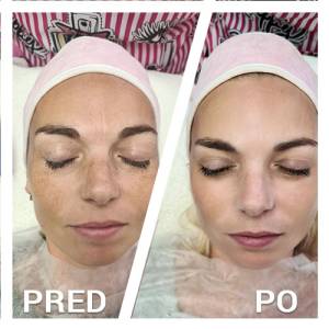 Nebojte sa chemického peelingu Nebojte sa chemického peelingu